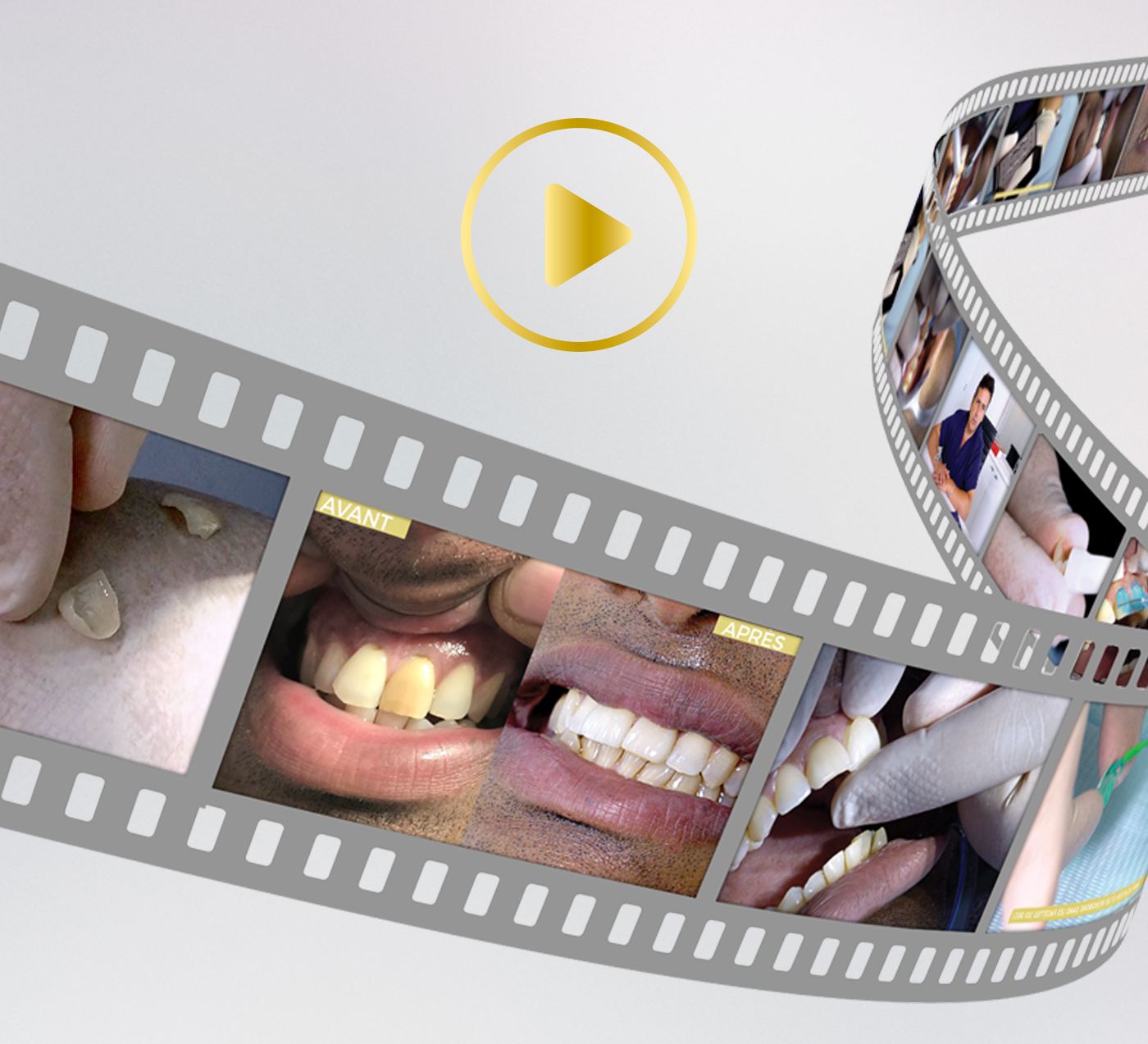Prothèse dentaire Protilab facettes pelliculaires easyfit®