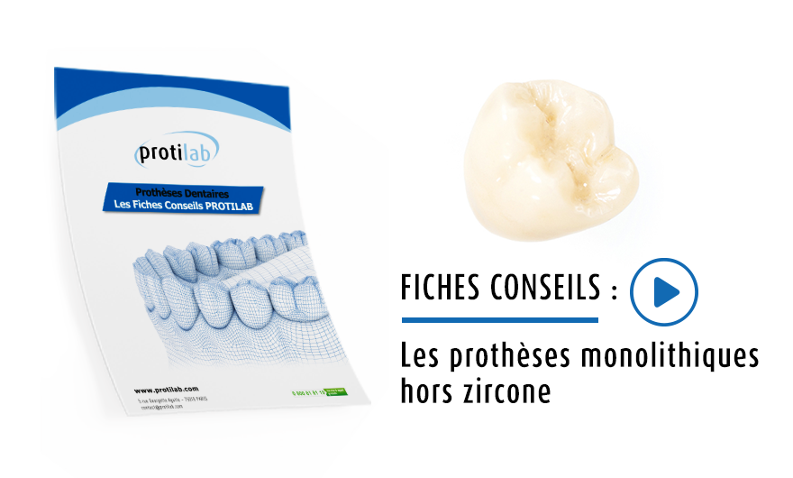 Fiches Conseils : les prothèses monolithiques hors zircone