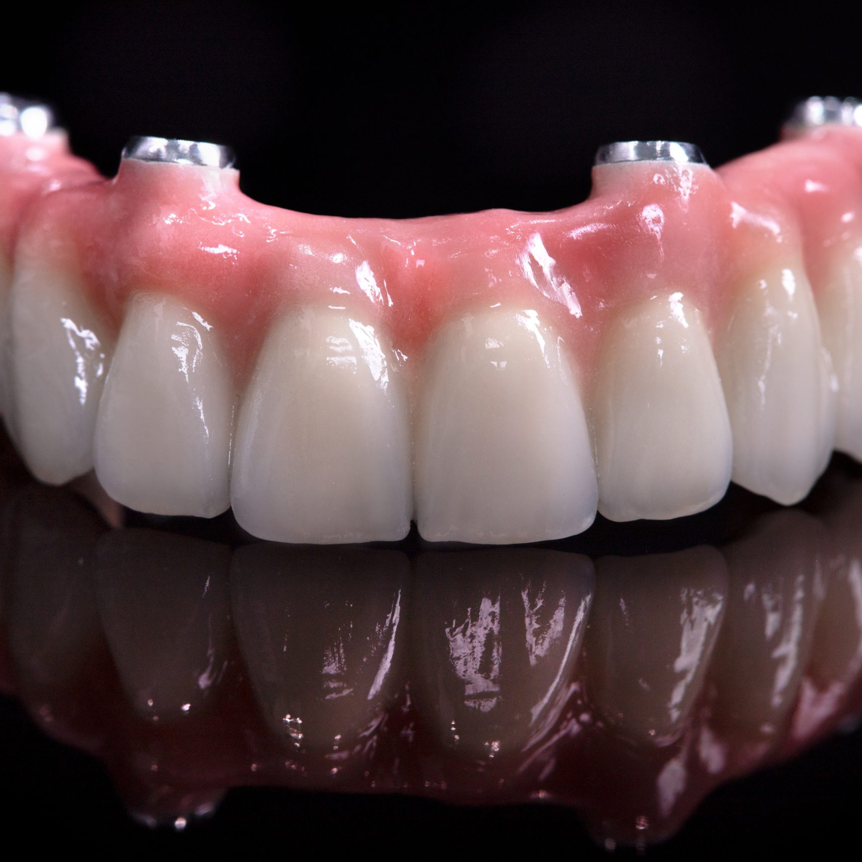 Prothèse dentaire fixe All-on-4 sur implants réalisée en flux numérique par un laboratoire de prothèse