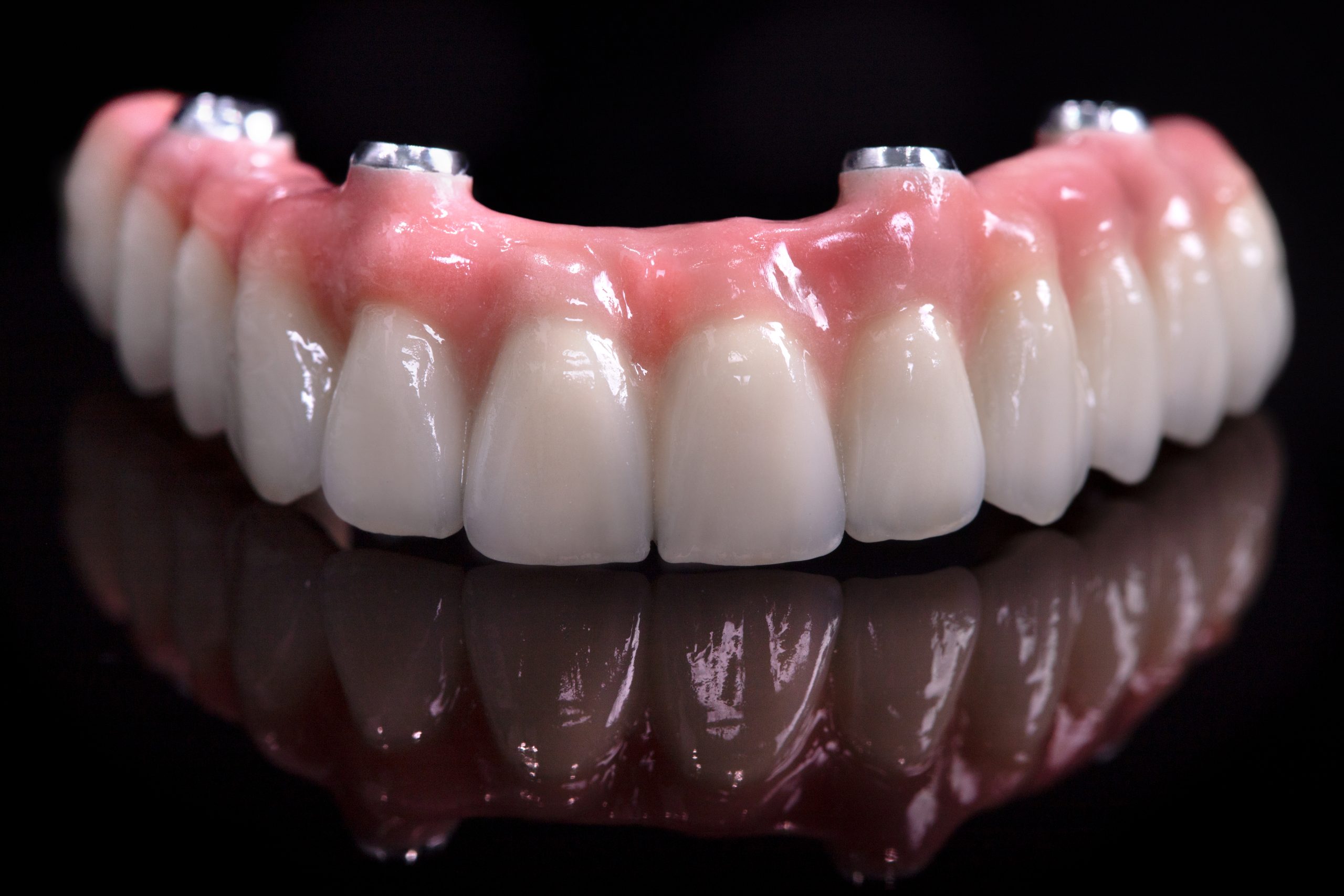 Prothèse dentaire fixe All-on-4 sur implants réalisée en flux numérique par un laboratoire de prothèse