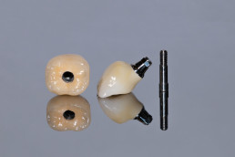 Couronne sur implant dentaire réalisée en flux numérique avec pilier implantaire et vis de fixation